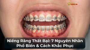 Visual illustration of niềng răng thất bại