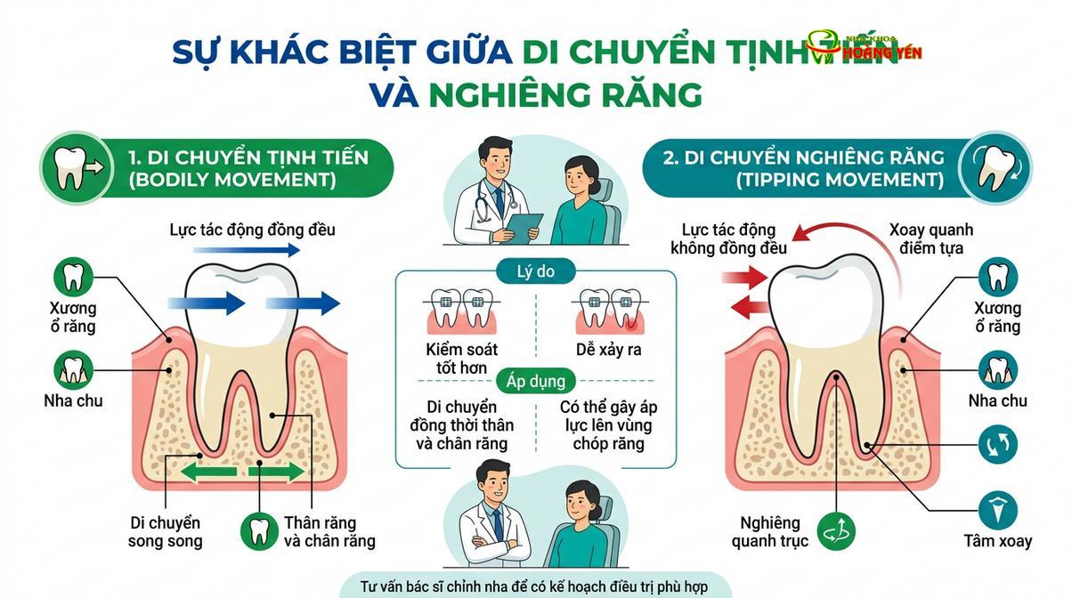 Sự khác biệt giữa di chuyển tịnh tiến (đúng kỹ thuật) và di chuyển nghiêng thân răng (sai kỹ thuật).