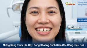 Niềng Răng Thưa (Kẽ Hở): Đóng Khoảng Cách Giữa Các Răng Hiệu Quả