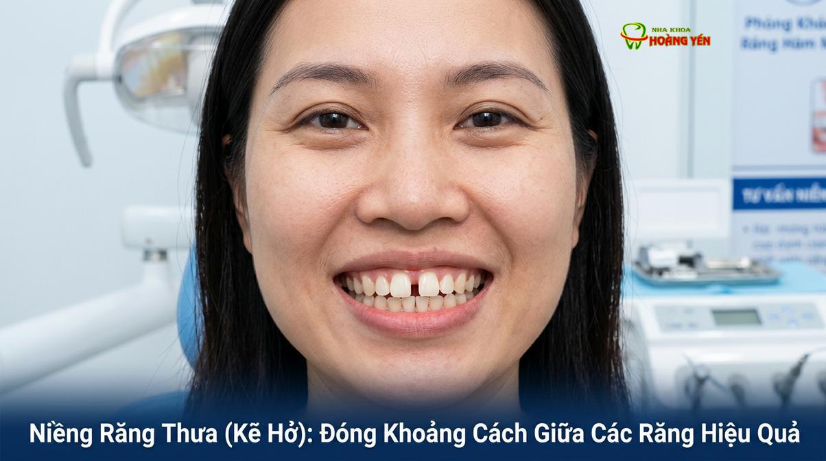 Tình trạng kẽ hở giữa 2 răng cửa (diastema) gây ảnh hưởng lớn đến thẩm mỹ nụ cười.