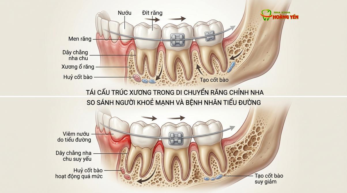 Mô phỏng quá trình tái cấu trúc xương ổ răng khi chịu lực tác động chỉnh nha.