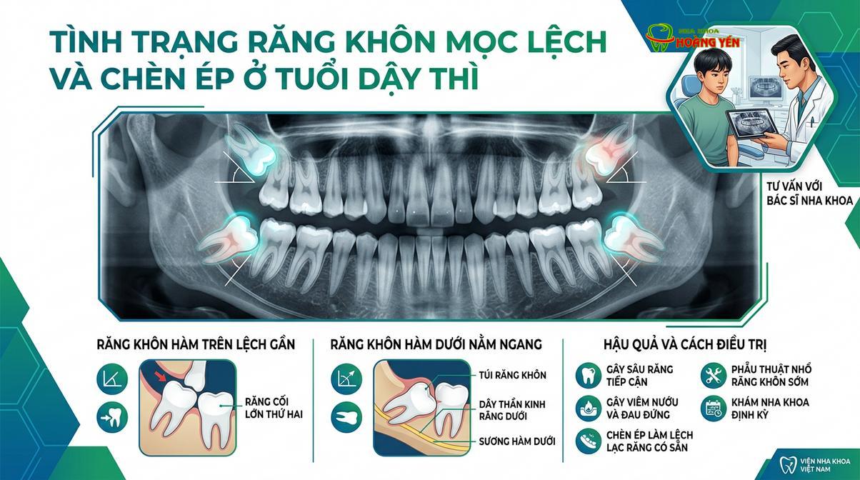 Răng khôn mọc ngầm có thể gây xô lệch toàn bộ kết quả chỉnh nha nếu không được xử lý kịp thời.