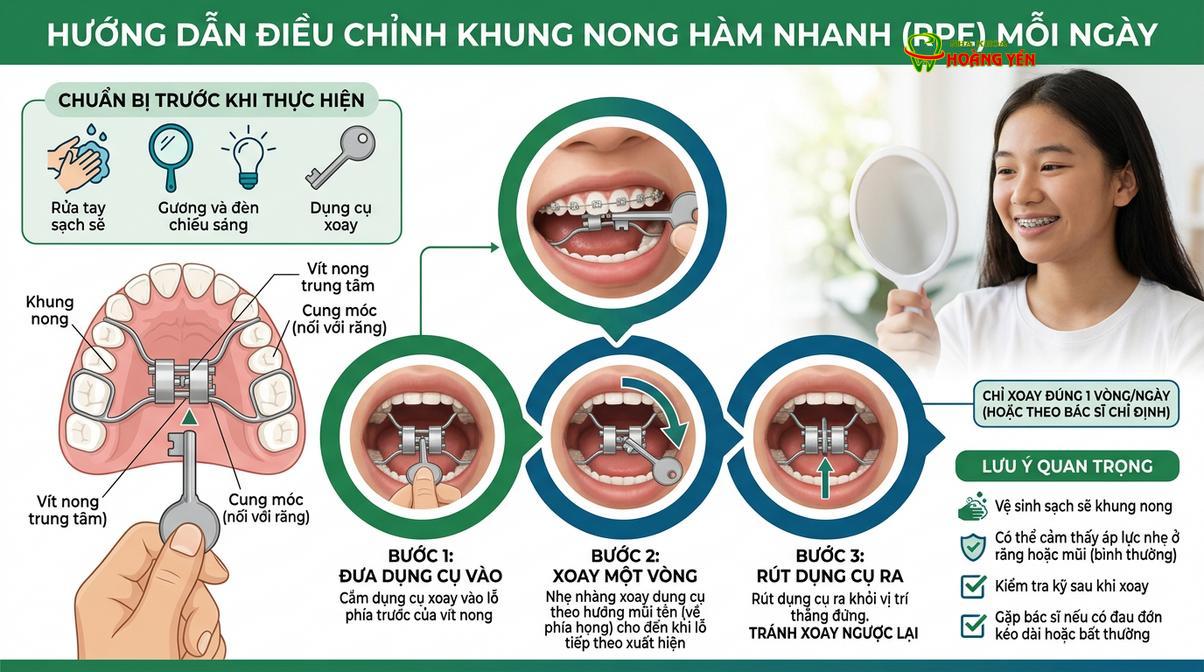 Hướng dẫn thao tác vặn ốc nong hàm đúng cách tại nhà.