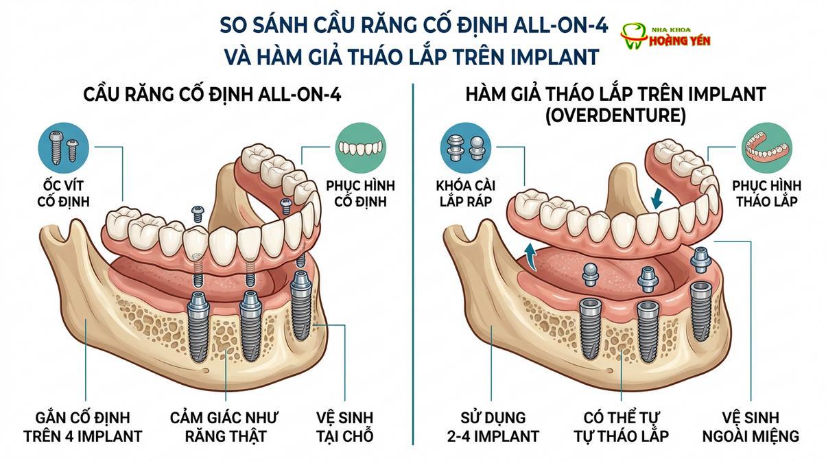 So sánh cơ chế chịu lực giữa phục hình cố định All-on-4 và hàm giả tháo lắp Overdenture.