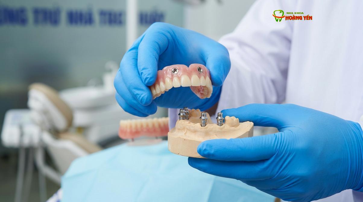 Hệ thống chốt Locator giúp hàm giả bám chặt vào trụ implant, hạn chế tình trạng lỏng lẻo.
