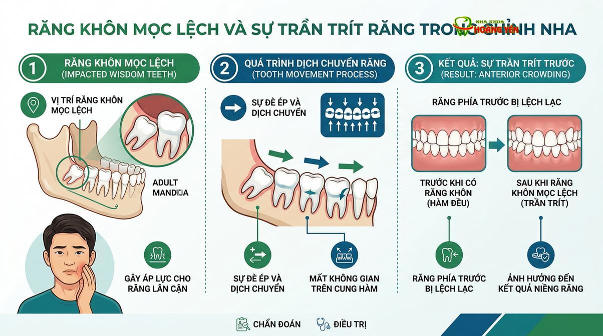 Khảo sát và xử lý răng khôn là bước quan trọng để bảo vệ kết quả chỉnh nha.
