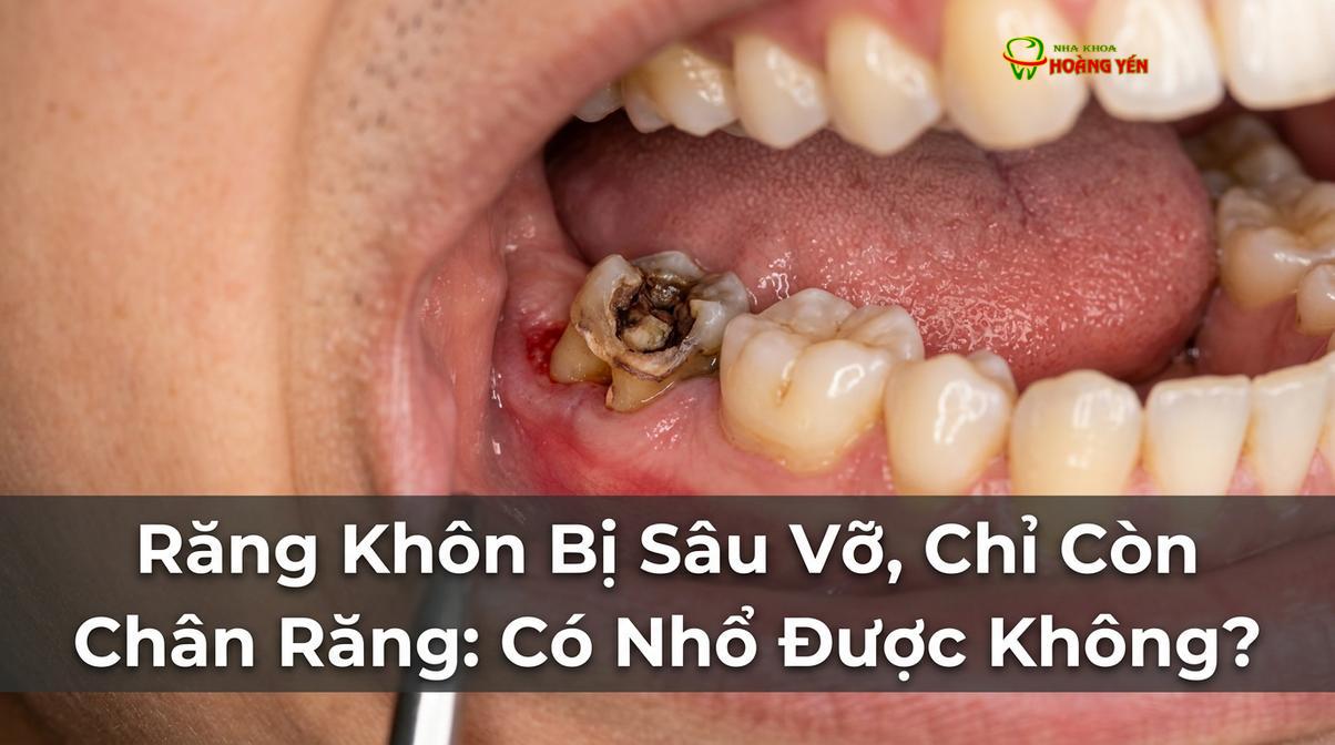 Răng khôn bị sâu vỡ nghiêm trọng, chỉ còn lại chân răng bám chặt trong xương hàm là tình trạng cần được thăm khám sớm.