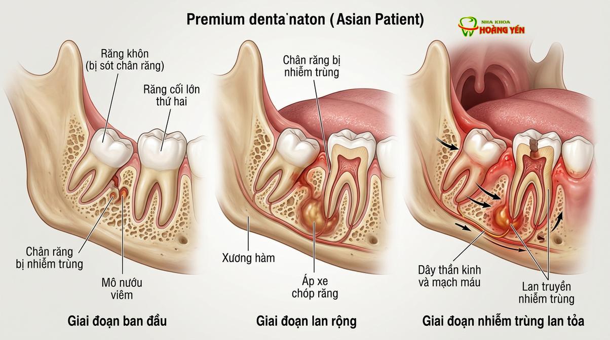 Chân răng khôn bị sâu hỏng nếu không được loại bỏ có thể gây viêm nhiễm lây lan sang răng cối lớn thứ hai.