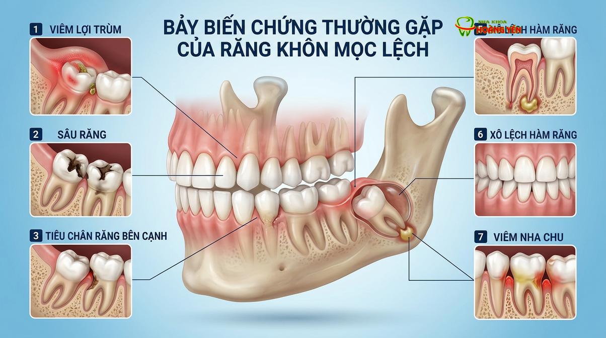 Mô phỏng các biến chứng nguy hiểm do răng khôn mọc lệch, mọc ngầm gây ra đối với cấu trúc hàm.