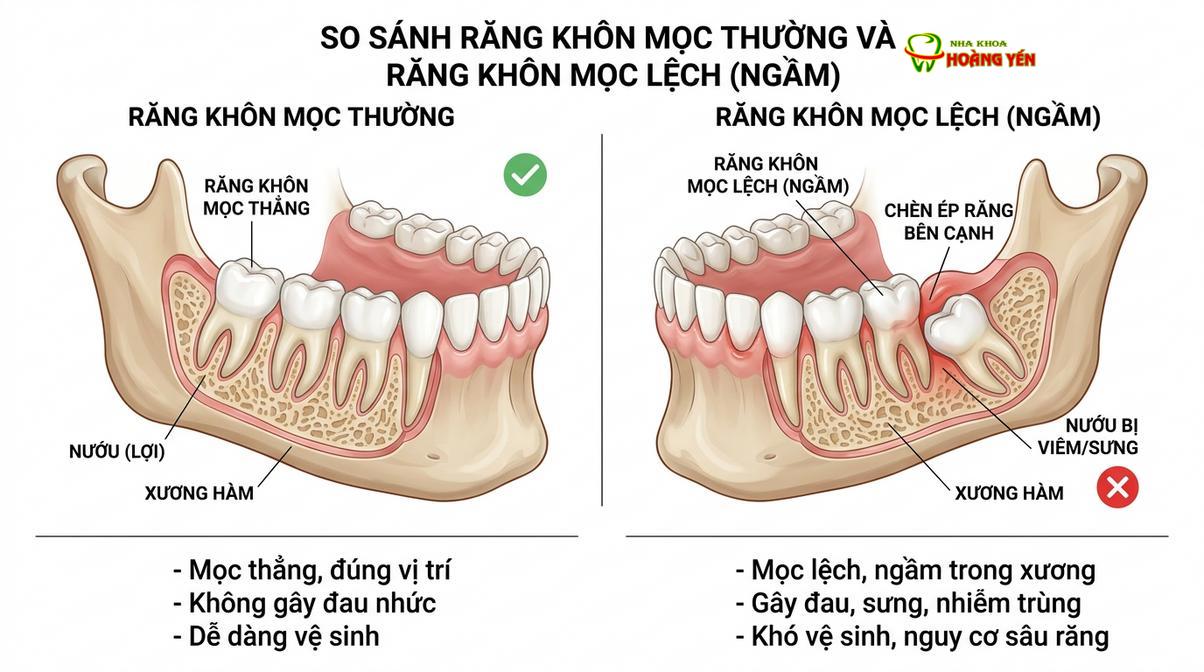 Sự khác biệt giữa răng khôn mọc thẳng bình thường và răng khôn mọc kẹt trong xương hàm.