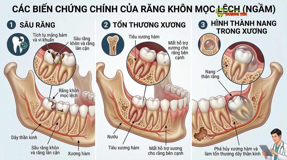 Các biến chứng nguy hiểm khi răng khôn chèn ép răng hàm số 7.