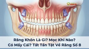 Visual illustration of răng khôn là gì