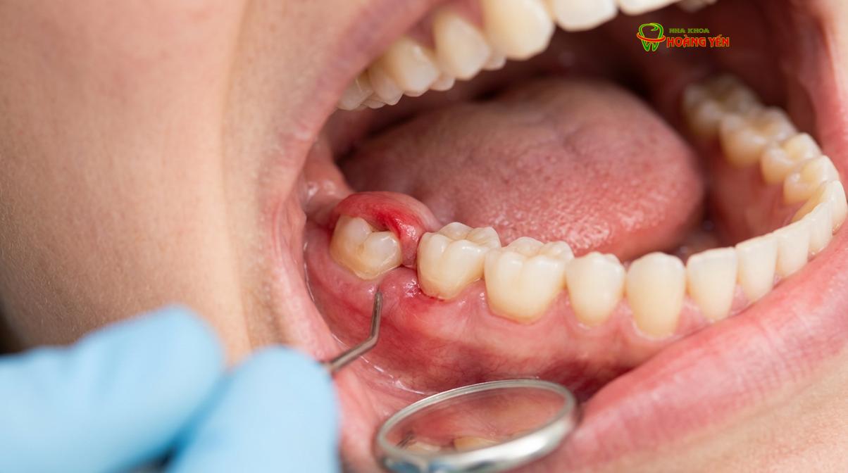 Hình ảnh minh họa dịch vụ răng khôn là gì