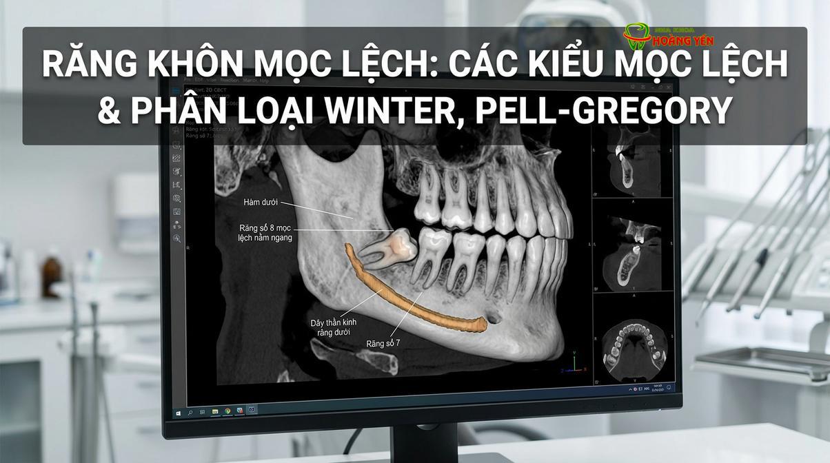 Hình ảnh phim CT Cone Beam 3D giúp bác sĩ khảo sát chính xác vị trí chân răng và dây thần kinh.