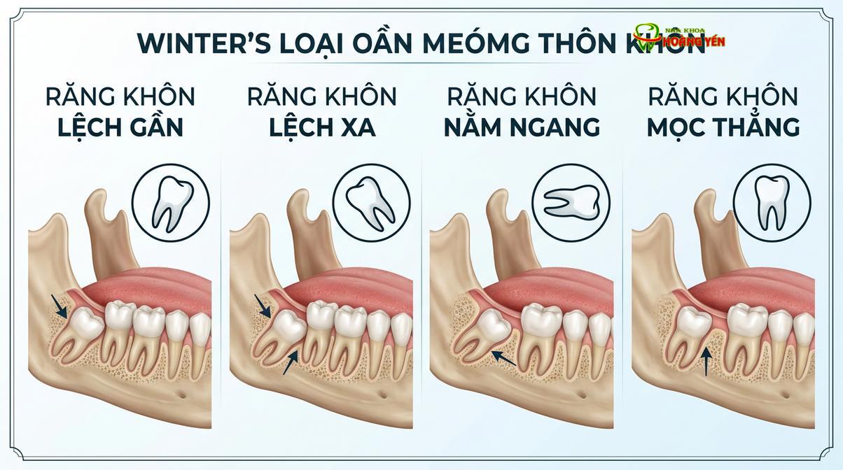 Các góc độ mọc lệch phổ biến của răng cối lớn thứ ba theo tiêu chuẩn phân loại y khoa.