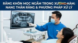 Răng Khôn Mọc Ngầm: Dấu Hiệu, Biến Chứng & Phẫu Thuật Bóc Tách