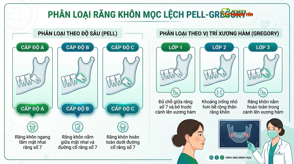 Phân loại các mức độ mọc ngầm của răng khôn trong xương hàm