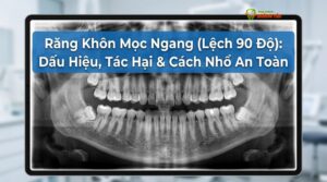 Visual illustration of răng khôn mọc ngang
