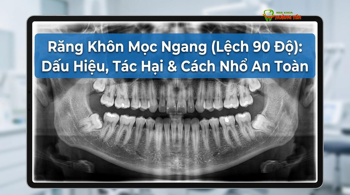Hình ảnh X-quang minh họa tình trạng răng khôn mọc ngang đâm vào răng số 7.