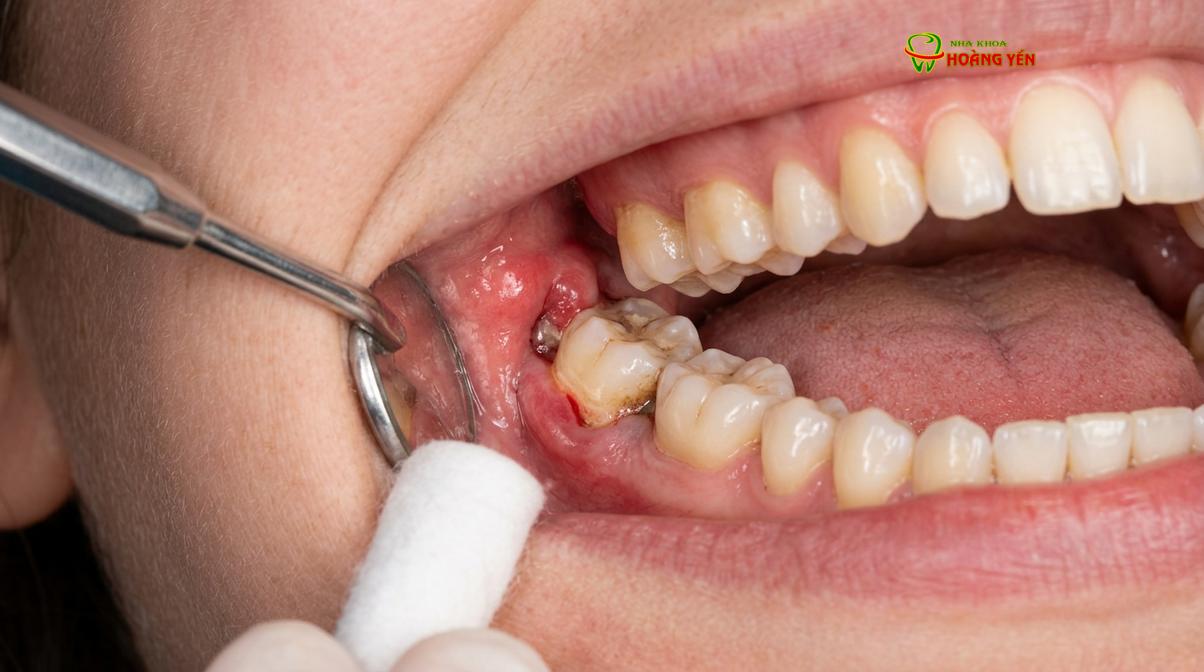 Tình trạng sưng viêm nướu (viêm lợi trùm) do răng khôn mọc kẹt gây ra.