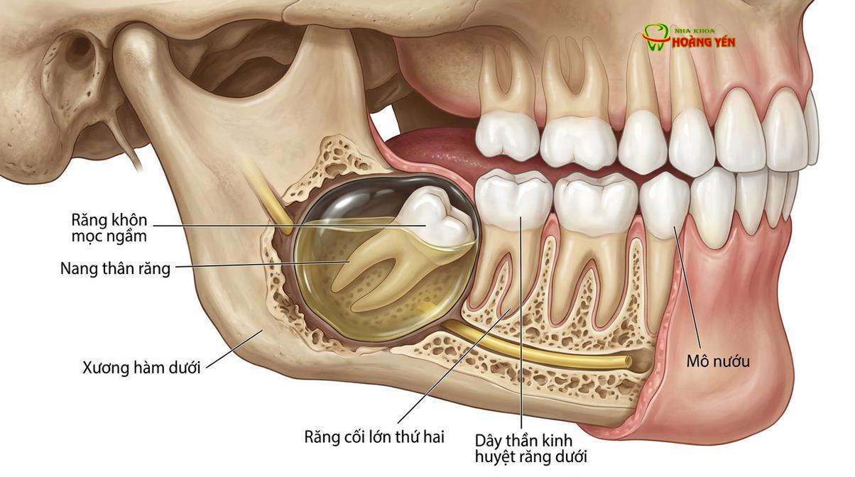 Mô phỏng sự hình thành nang thân răng khi răng khôn mọc ngầm không được xử lý.