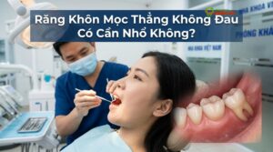 Visual illustration of răng khôn mọc thẳng có cần nhổ không