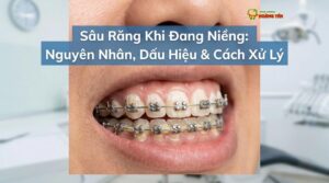 Sâu Răng Khi Niềng: Nguyên Nhân, Dấu Hiệu & Cách Xử Lý