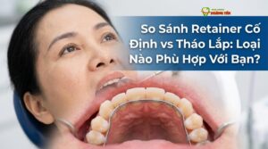 Visual illustration of so sánh retainer