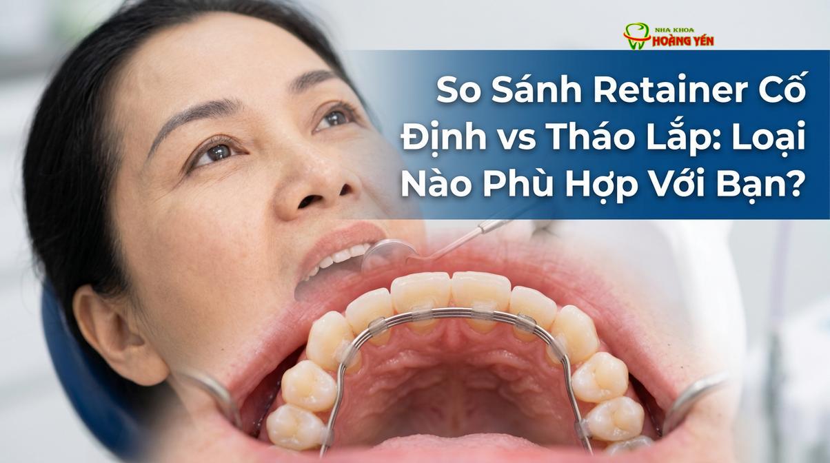Retainer cố định (Bonded Retainer) được gắn vào mặt trong của các răng cửa.