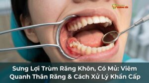 Visual illustration of sưng lợi trùm răng khôn