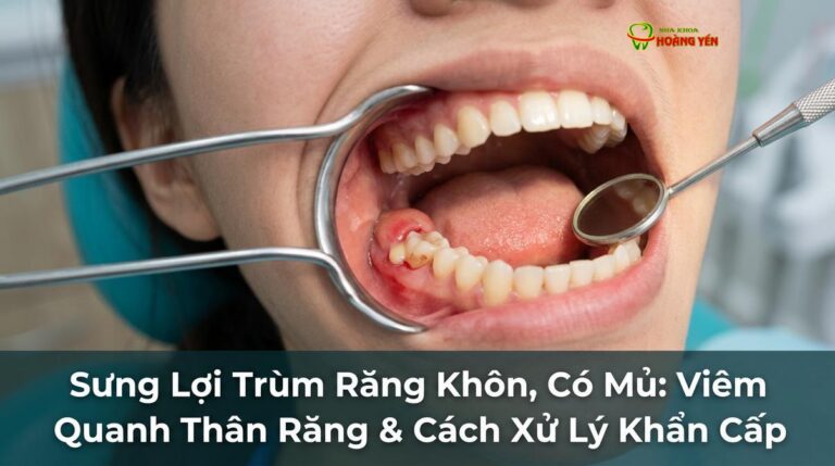 Sưng Lợi Trùm Răng Khôn, Có Mủ: Viêm Quanh Thân Răng & Cách Xử Lý