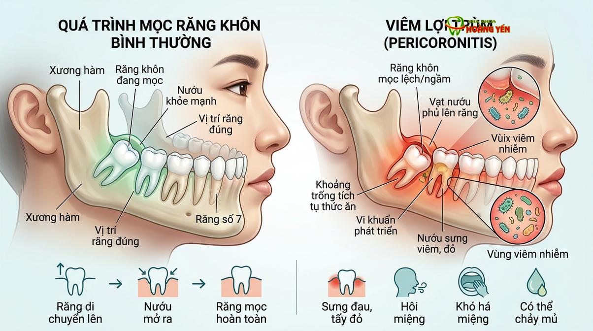 Bảng tóm tắt trực quan phân biệt quá trình mọc răng sinh lý bình thường và bệnh lý viêm lợi trùm.
