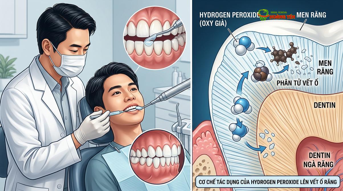 Cơ chế hoạt động của thuốc tẩy trắng giúp cắt đứt các chuỗi phân tử tạo màu bên trong ngà răng.