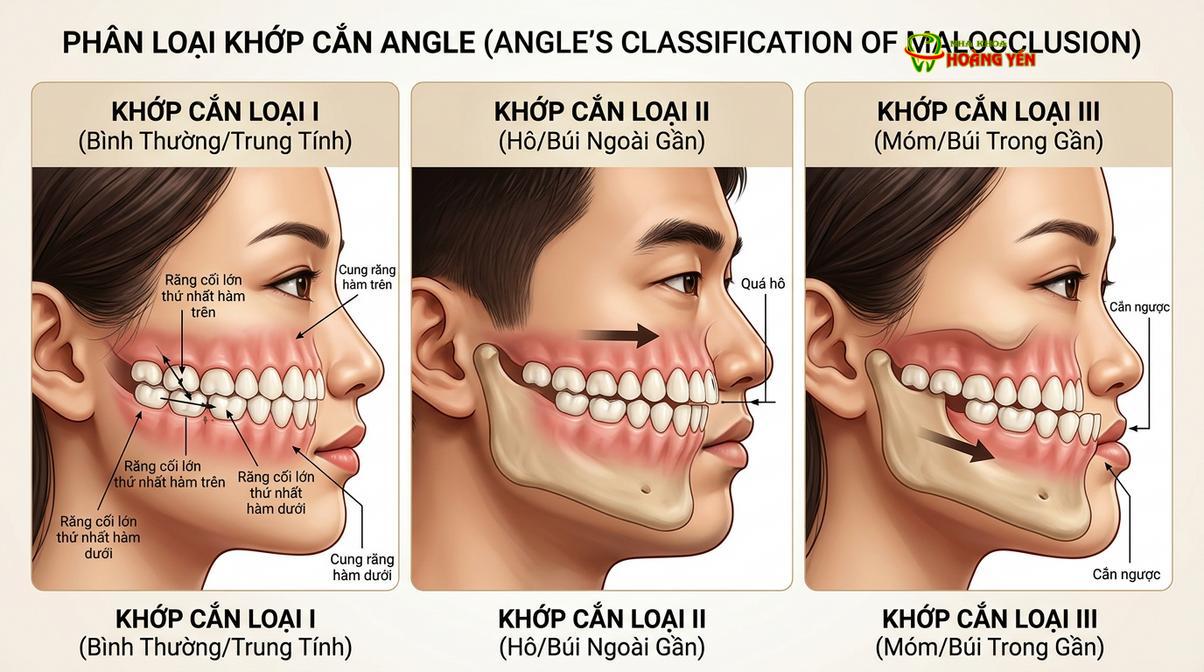 Minh họa các phân loại sai lệch khớp cắn cơ bản trong chỉnh nha.