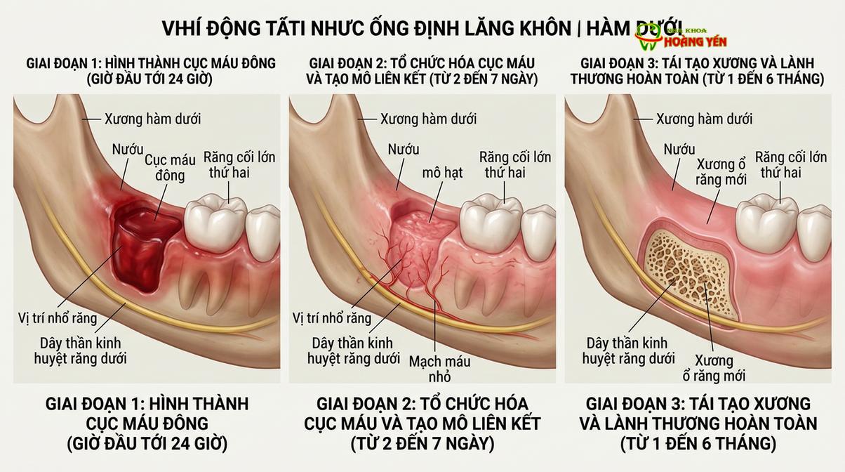 Quá trình lành thương tại ổ răng khôn phụ thuộc rất lớn vào việc kiểm soát viêm nhiễm bằng thuốc.