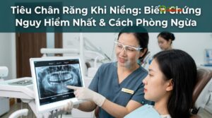Visual illustration of tiêu chân răng khi niềng
