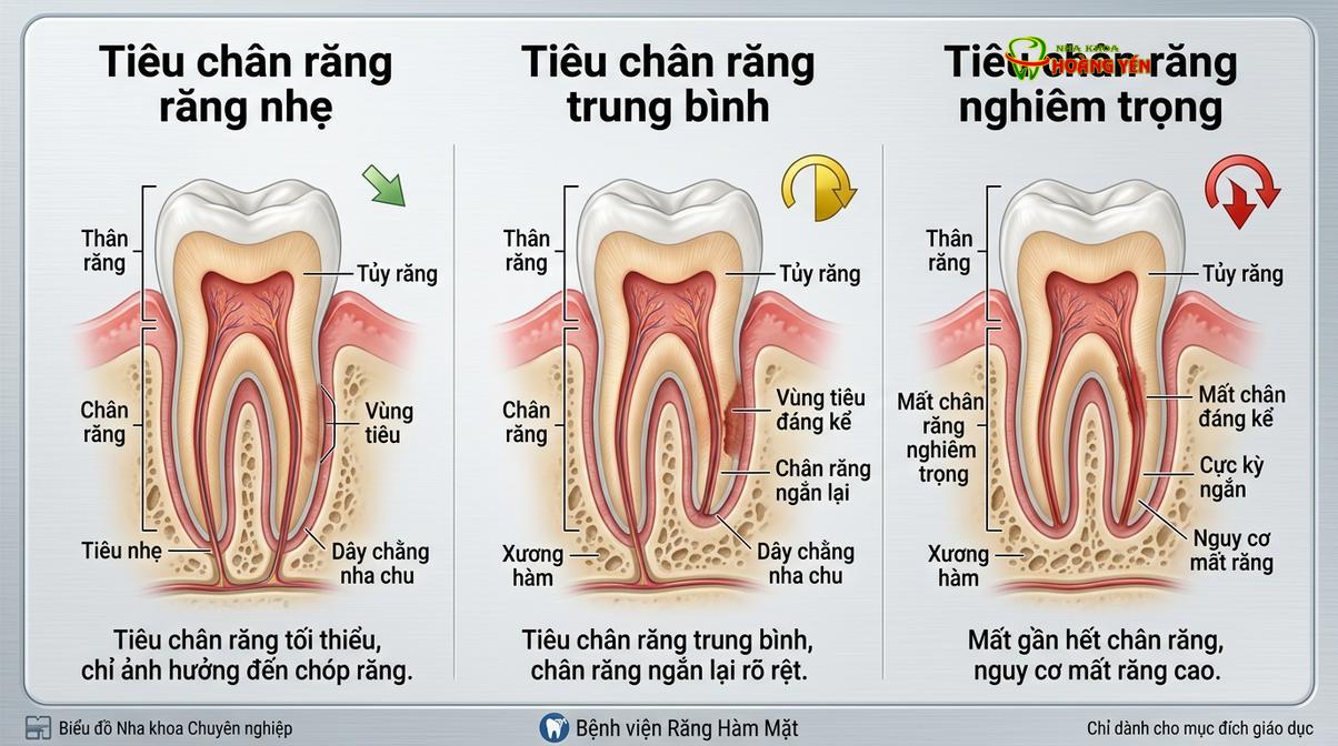 Các mức độ tiêu chân răng thường gặp trên lâm sàng.