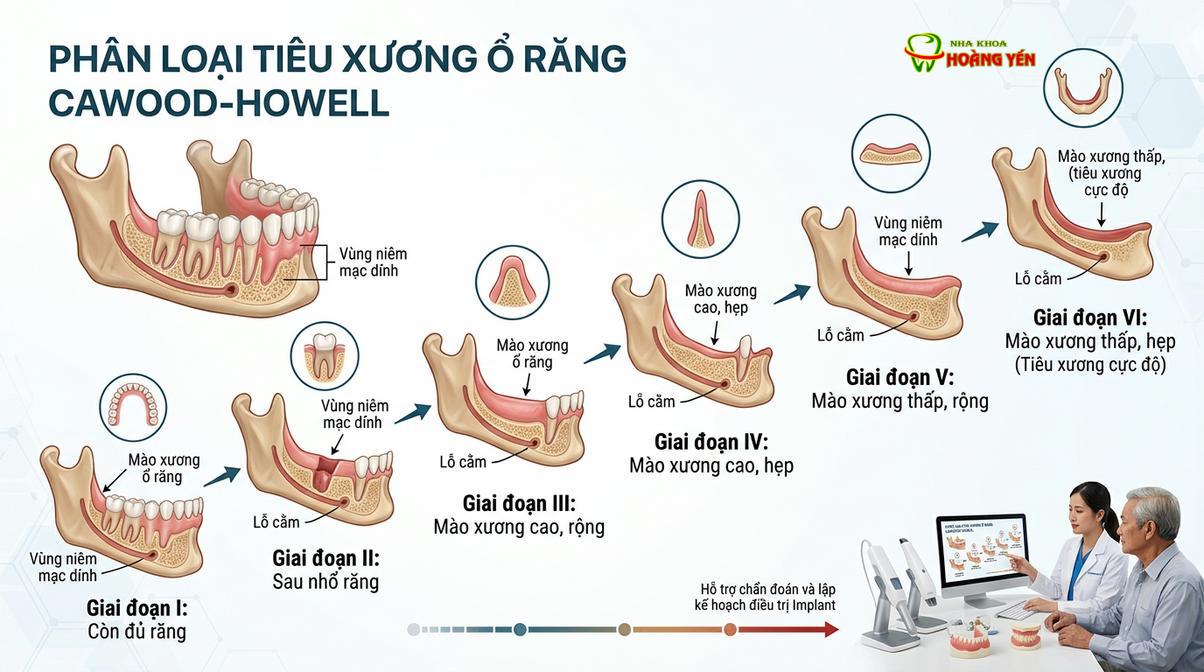 Sơ đồ minh họa các mức độ thoái hóa xương hàm theo phân loại y khoa.