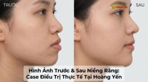 Visual illustration of trước sau niềng răng