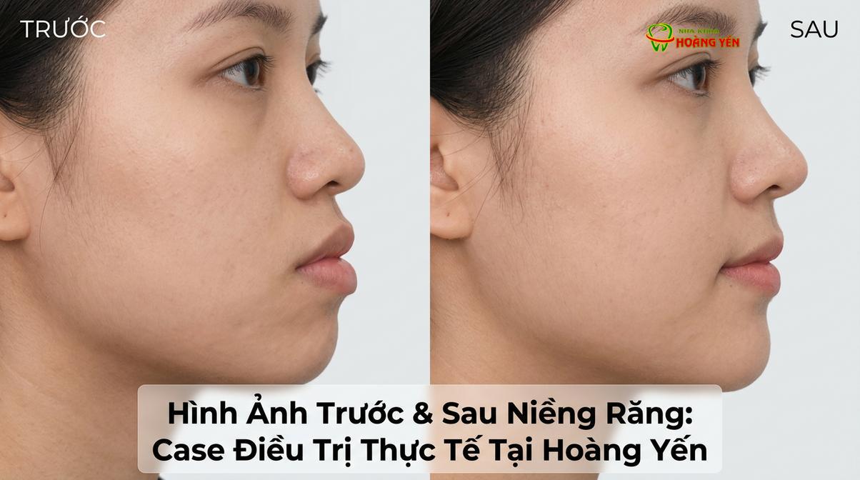 Sự thay đổi góc nghiêng và độ nhô của môi là một trong những khác biệt rõ rệt nhất sau quá trình chỉnh nha.
