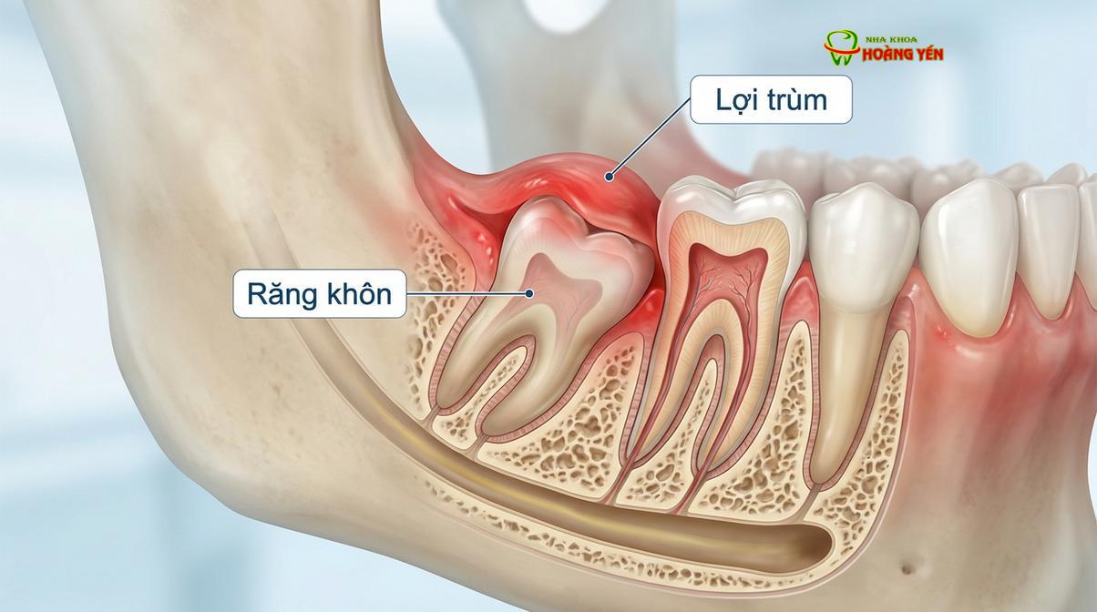 Tình trạng sưng lợi trùm răng khôn cần được xử lý triệt để trước khi bước vào lộ trình niềng răng.