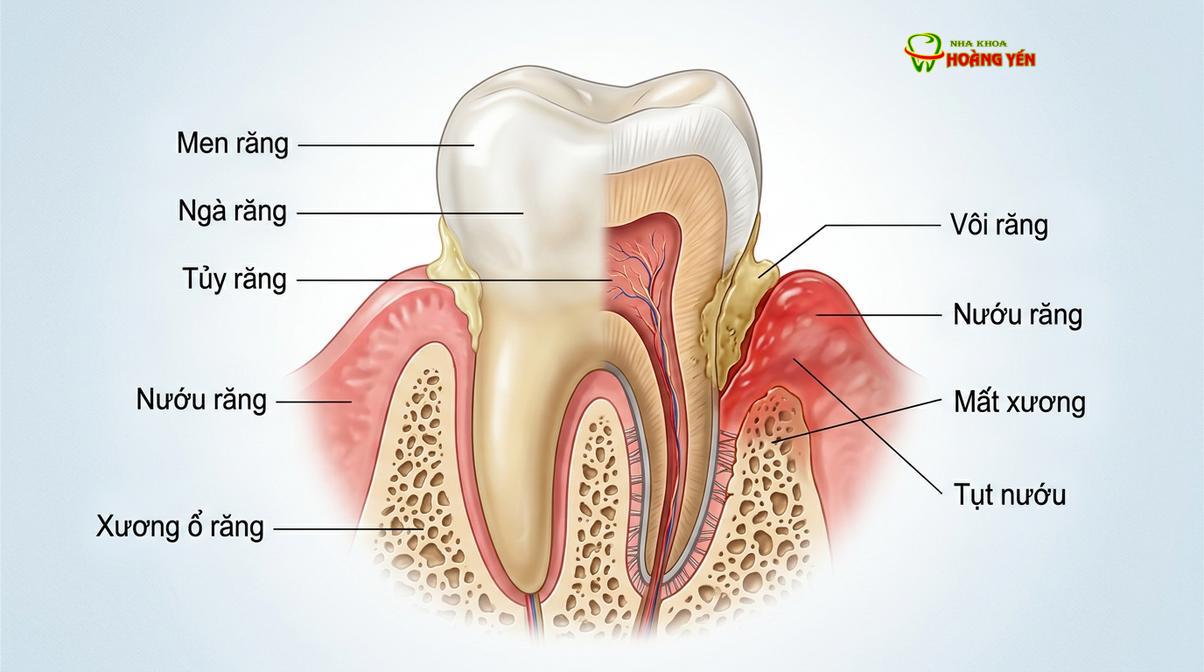 Mô phỏng y khoa quá trình mảng bám và vi khuẩn tấn công phá hủy mô nha chu, dẫn đến hiện tượng nướu co rút.
