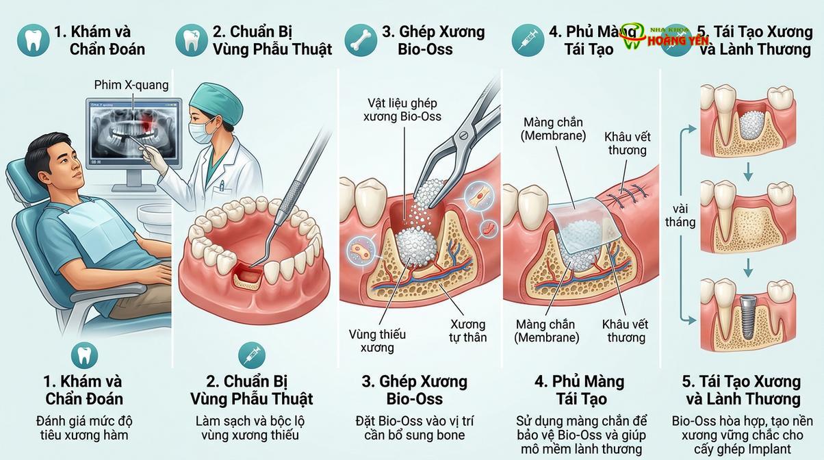 Mô phỏng quá trình ghép xương nhân tạo giúp tái tạo thể tích xương hàm trước khi cấy ghép.