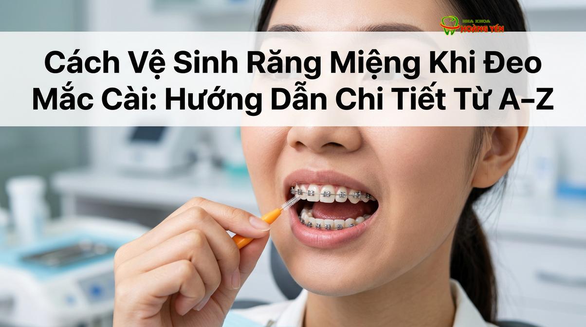 Sử dụng bàn chải kẽ là bước quan trọng để làm sạch vùng không gian hẹp giữa hai mắc cài và dưới dây cung.