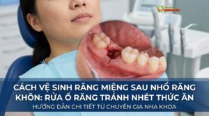 Cách Vệ Sinh Răng Miệng Sau Nhổ Răng Khôn: Rửa Ổ Răng Tránh Nhét Thức Ăn