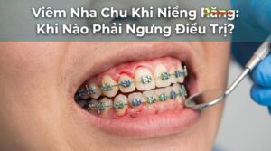Visual illustration of viêm nha chu khi niềng