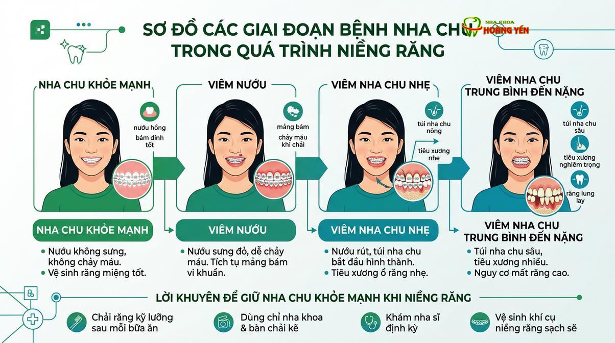 Các giai đoạn tiến triển của bệnh lý nha chu nếu không được kiểm soát kịp thời.
