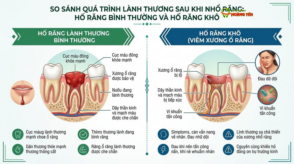 Mô phỏng sự khác biệt giữa quá trình lành thương bình thường và tình trạng viêm xương ổ răng.